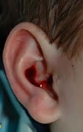 Sangue orecchie neonato e bambino, cause 