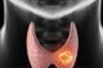 Scoperta una molecola che fa scoppiare le cellule del cancro - TGCOM