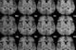 Sclerosi multipla, disturbi cognitivi per 70% dei pazienti - SuperAbile