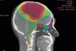 Rimosso il tumore al cervello più grande del mondo da 1,8 kg