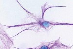 Primo trapianto di cellule staminali cerebrali per combattere la Sla