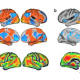 Alzheimer, così il cervello si difende - Quotidiano.net